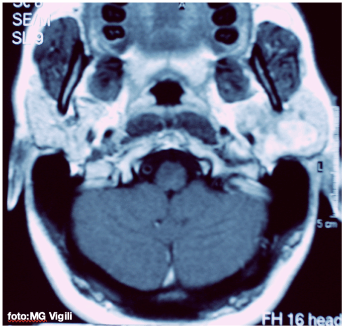 recidive di adenoma pleomorfo