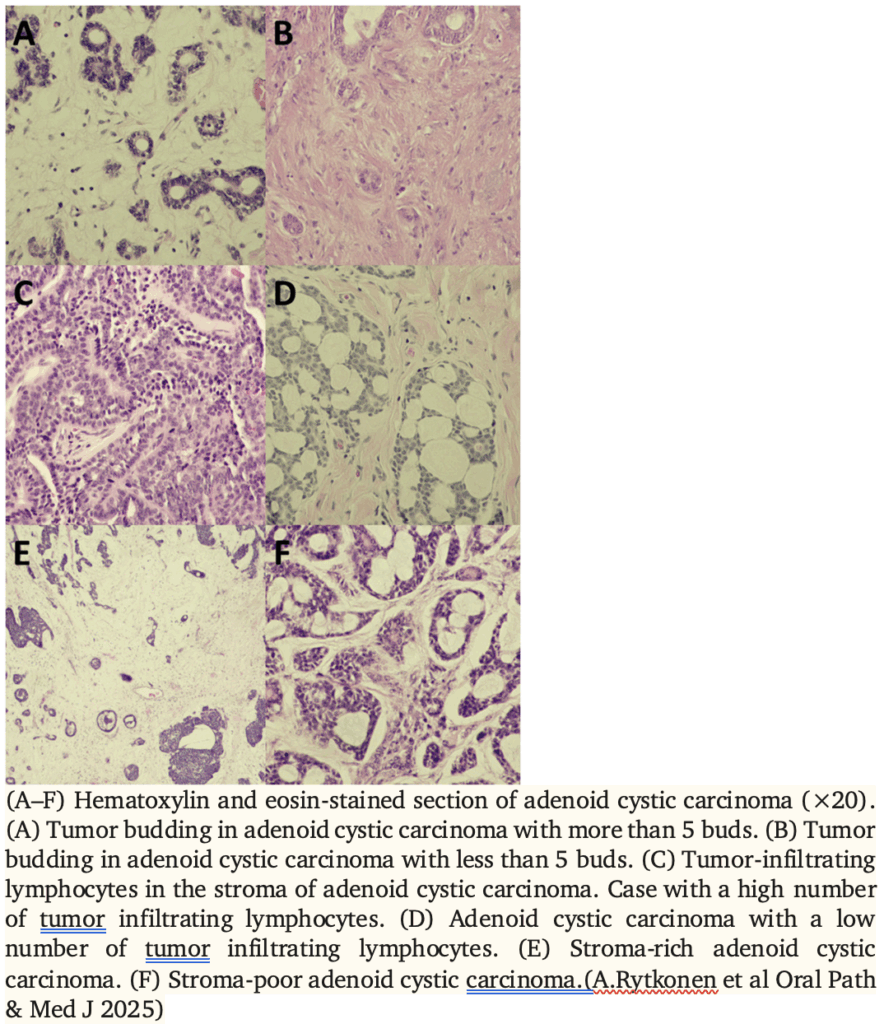 carcinoma adenoido cistico delle ghiandole salivari