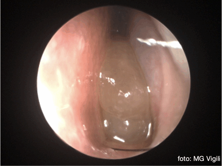 dupilumab e sinusite cronica effetti avversi
