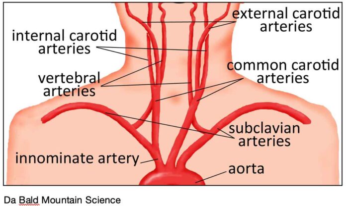 fistola trachea arteria innominata