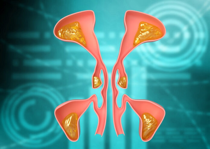 nasal sinus with internal demonstration of sinusitis, facial inflammation that causes headache and malaise
