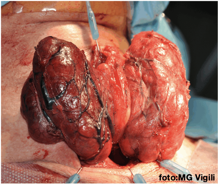 rapporto neutrofili:linfociti biomarker nei tumori papilliferi della tiroide
