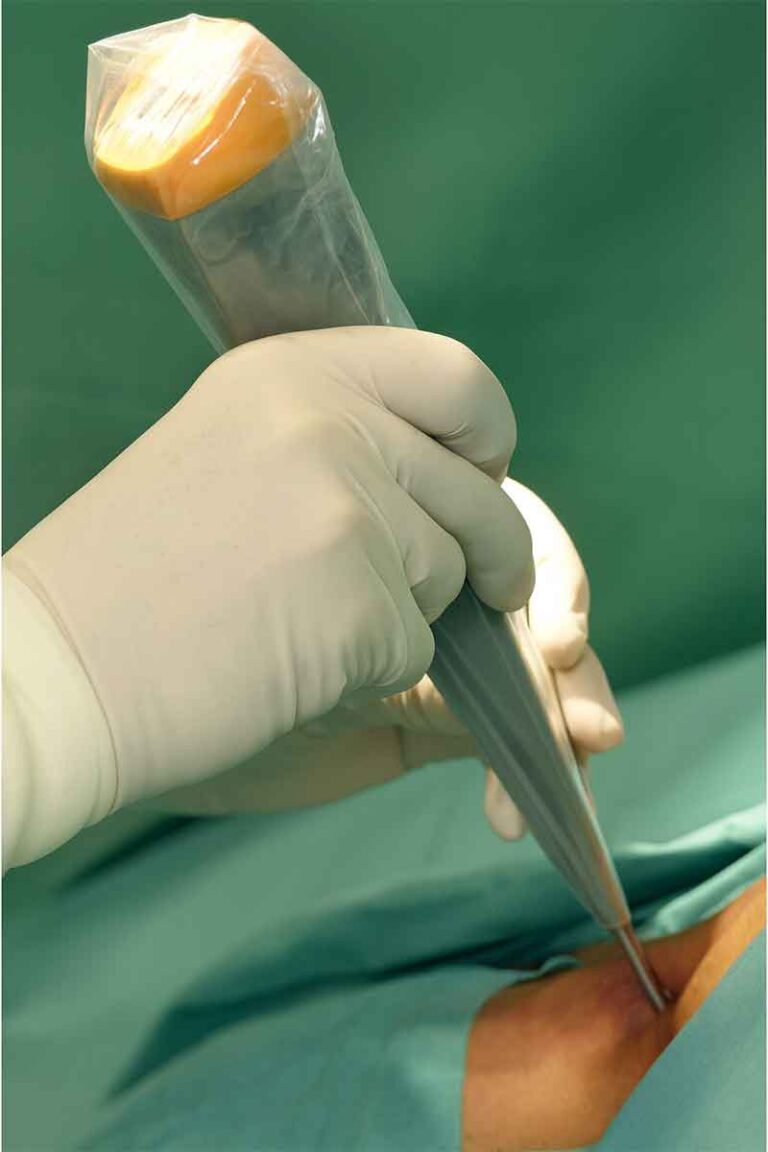 biopsia del linfonodo sentinella tumori cavo orale chatgpt image 9 dic 2025, 16 50 44