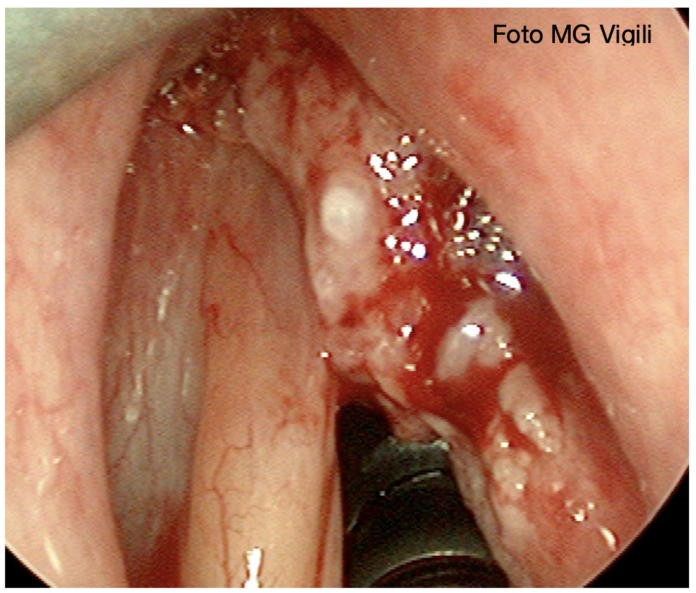 consensus sul follow up dei tumori glottici t1 t2
