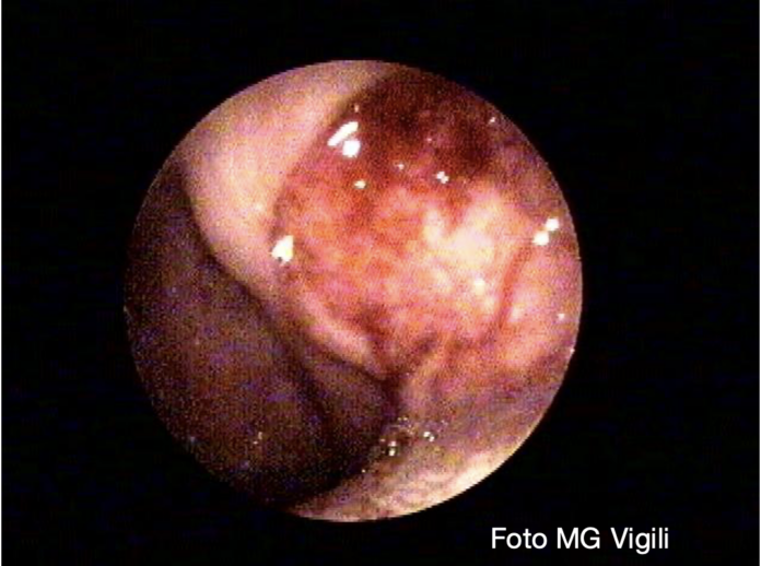 maggior rischio di metastasi linfonodali nei giovani con carcinoma squamoso della tonsilla t1