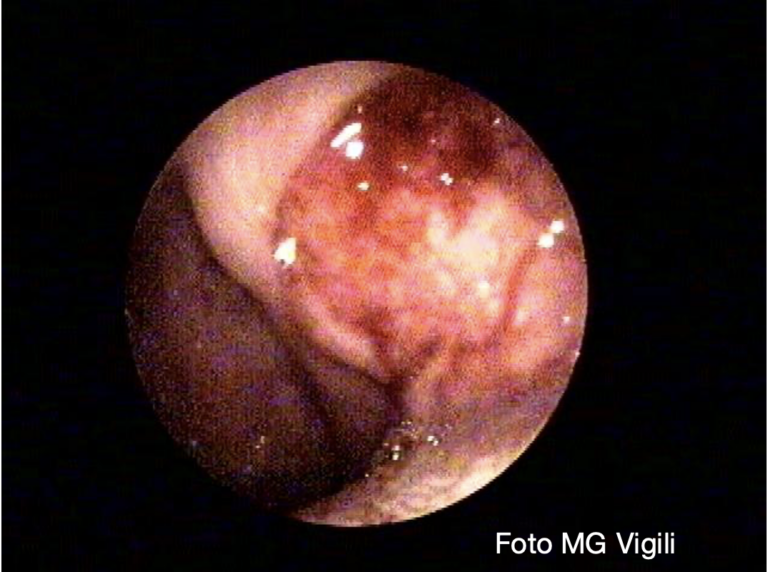 maggior rischio di metastasi linfonodali nei giovani con carcinoma squamoso della tonsilla t1
