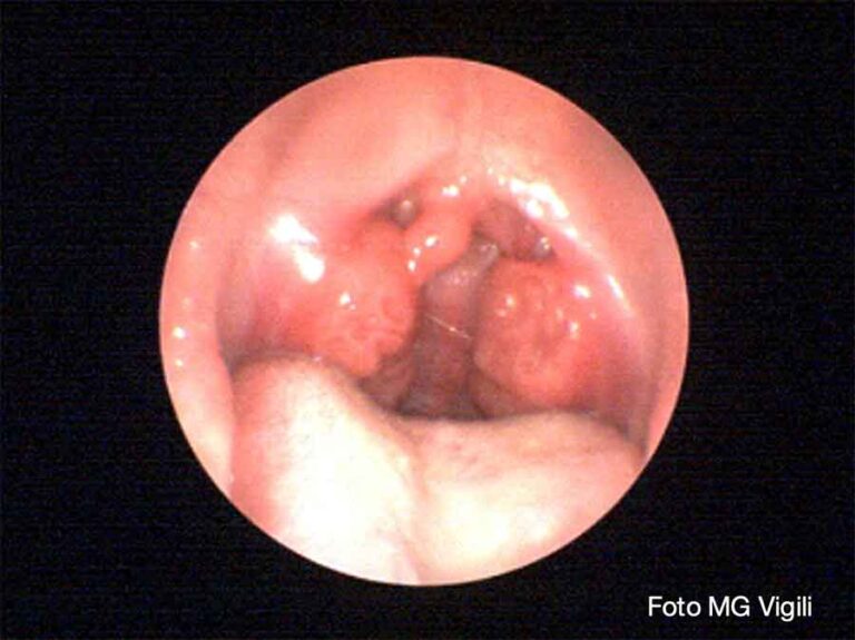 ipertrofia di adenoidi e tonsille