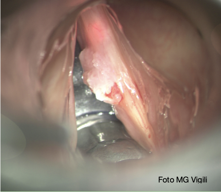 leucoplachia delle corde vocali