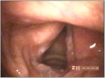 leucoplachia delle corde vocali