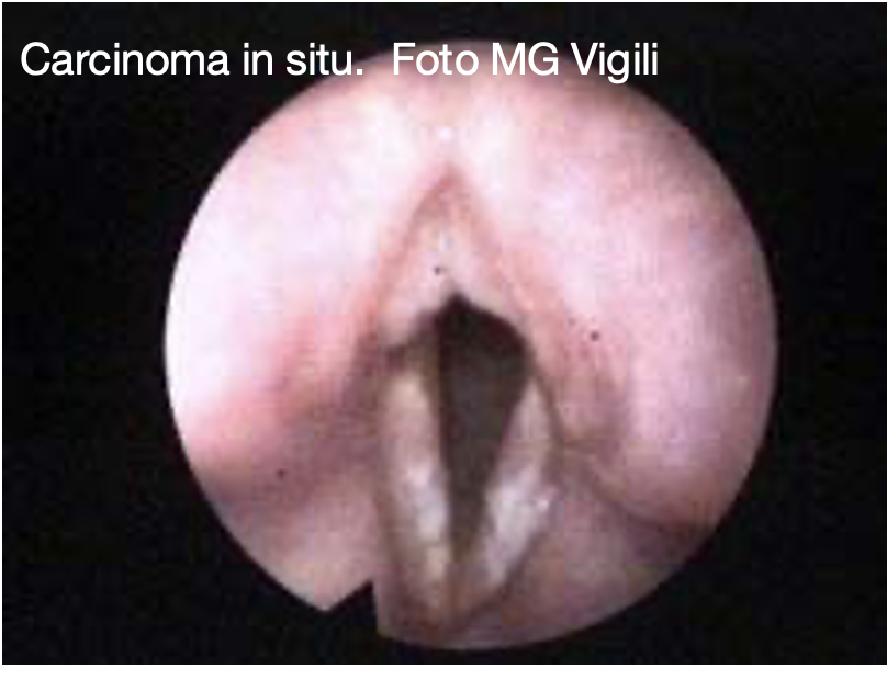 leucoplachia delle corde vocali 2