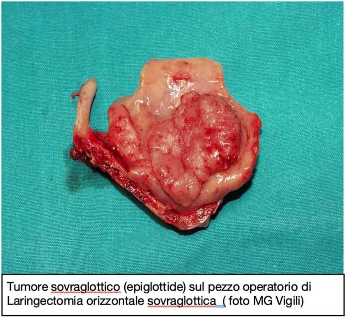 ruolo della laringectomia parziale open nel trattamento dei tumori laringei