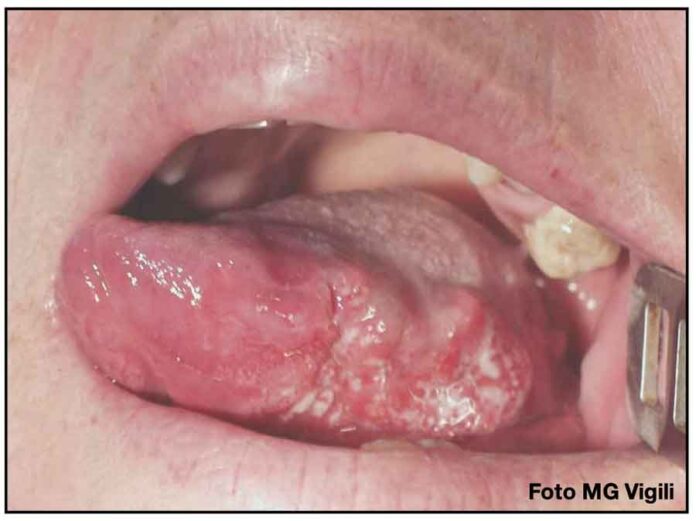 valore prognostico di ki 67 nei tumori del cavo orale