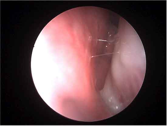 nuovo strumento per valutare la ostruzione nasale nasal obstruction disability index (nosi)
