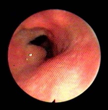 granuloma laringeo e reflusso