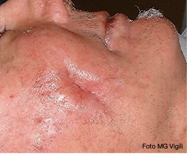 infiltrazione cutanea