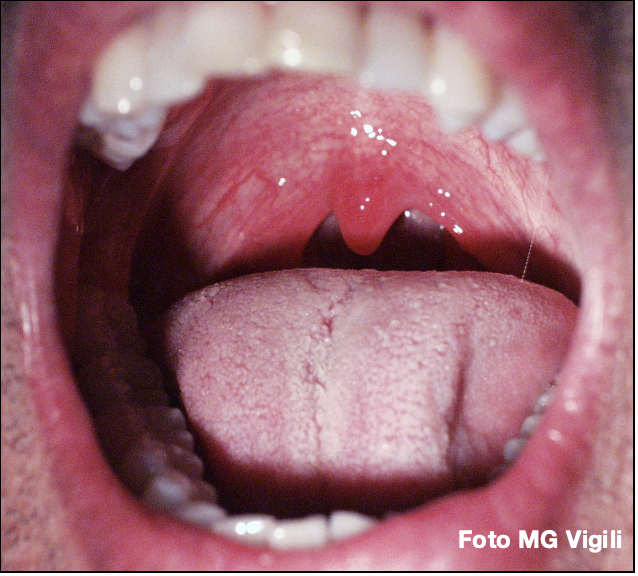 ascesso peritonsillare