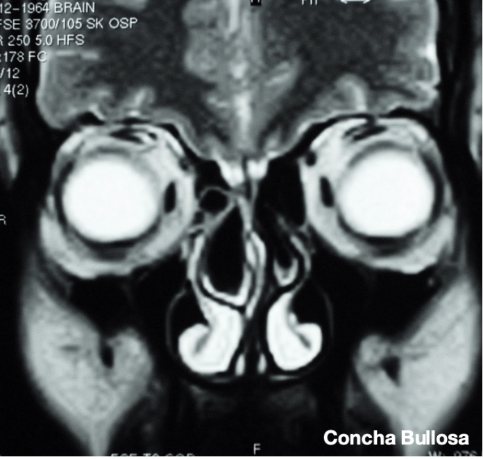 varianti anatomiche rinosinusali e sinusite cronica