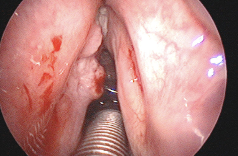 papillomatosi laringea ricorrente