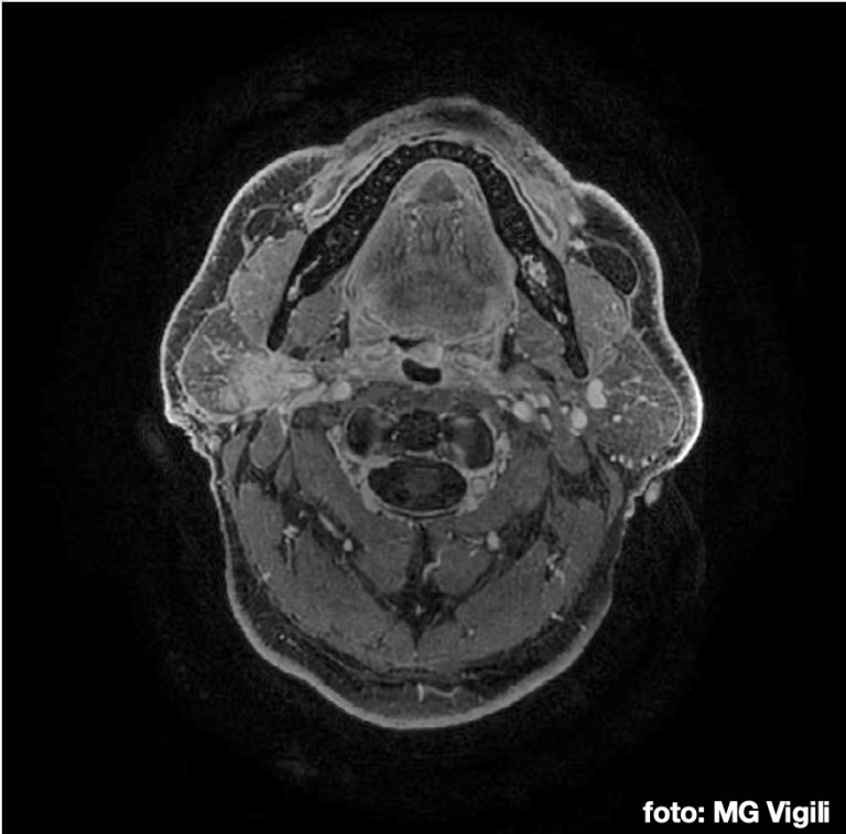 tumori maligni delle ghiandole salivari maggiori