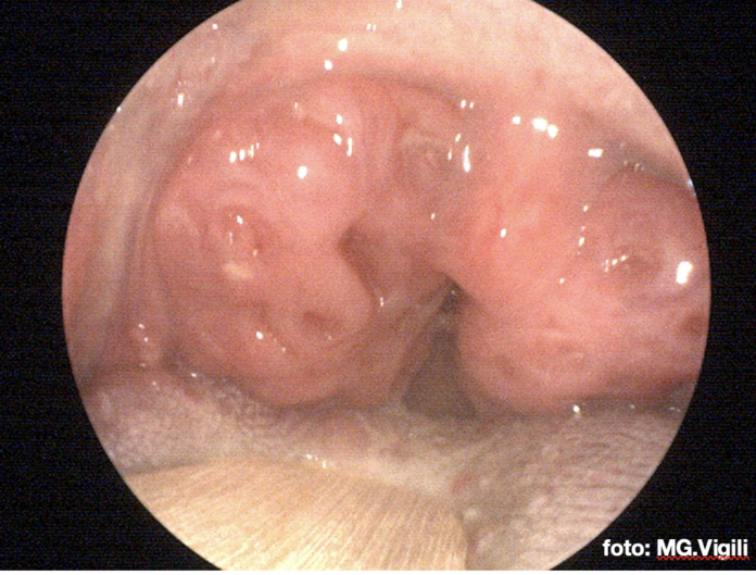 adenotonsillectomia