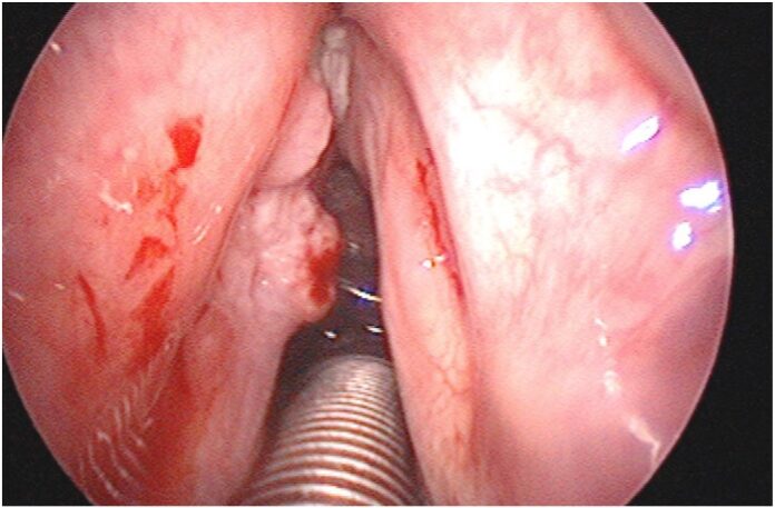 papillomatosi respiratoria