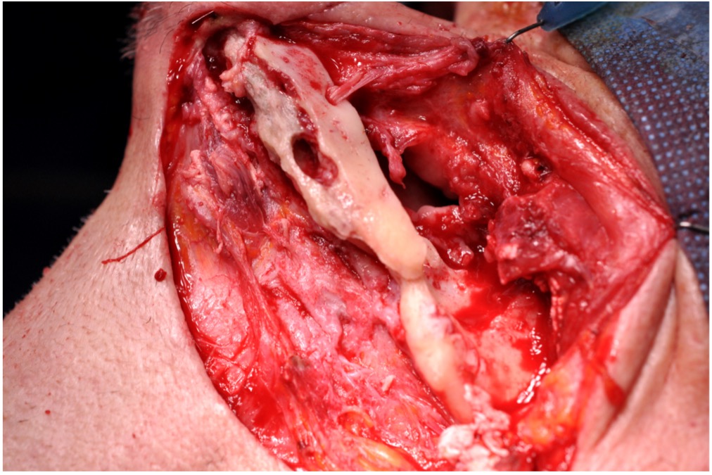 osteonecrosi 3