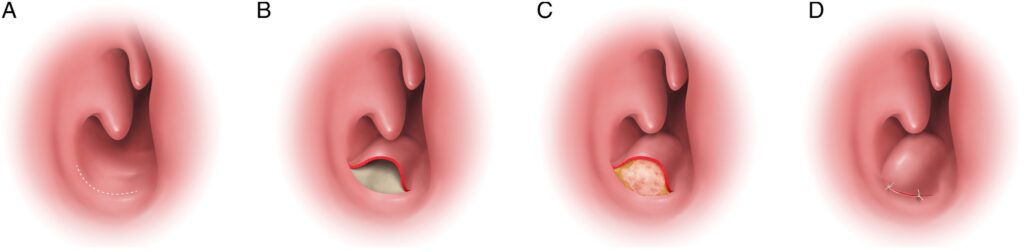 sindrome empty nose