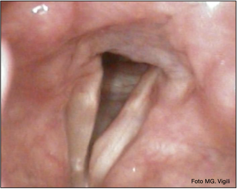 laringoplastica iniettiva transnasale endoscopica ambulatoriale